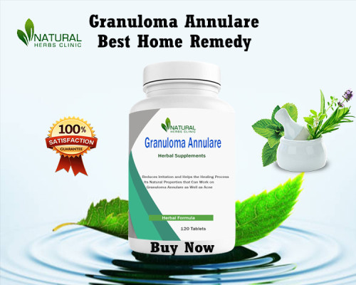 Explore Granuloma Annulare Treatment Natural and safe, an autoimmune skin condition causing ring-shaped rashes and lesions. Alternative remedies and lifestyle changes may help reduce flare-ups and symptoms. https://digitalville.net/home-remedies-for-granuloma-annulare-treatment-natural-10-natural-treatments-you-havent-tried/