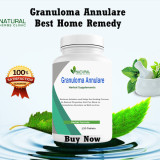 Herbal-Remedies-for-Granuloma-Annulare