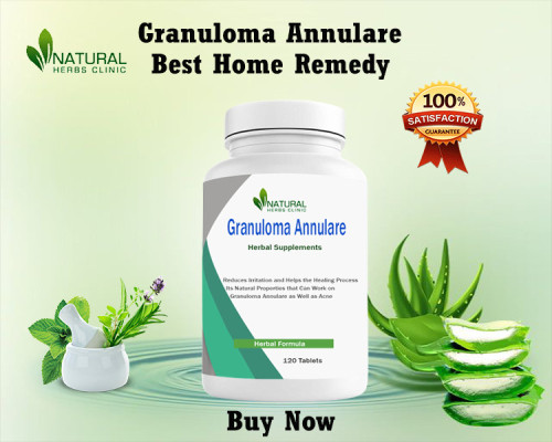 Gain insight into the possible Granuloma Annulare Treatment at Home options such as home remedies, supplements, light therapy, steroids, salicylic acid, and dietary changes that may help reduce symptoms. https://pharmahub.org/members/21370/blog/2023/05/how-to-get-granuloma-annulare-treatment-at-home--safe-solutions-for-home-use