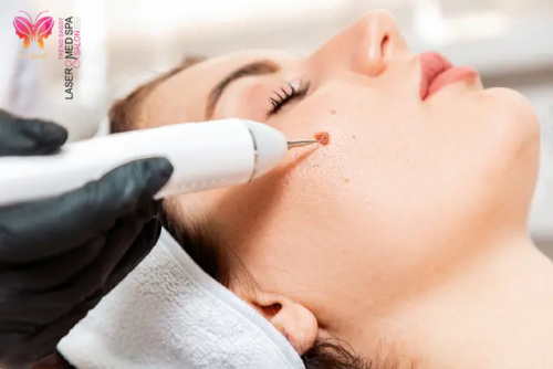 Skin tags and warts can make your skin look lifeless. Meet with our expert for skin tag removal in Ontario. Book your appointment instantly.

https://trendsassy.ca/skin-tag-removal