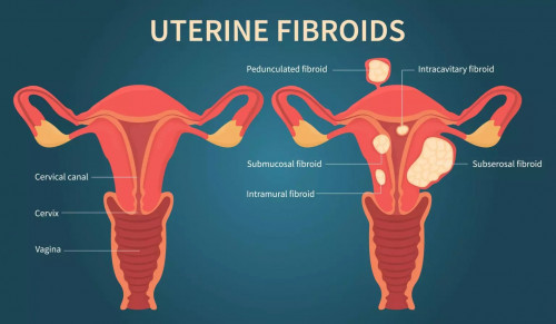 Explore a comprehensive gallery of fibroid pictures to better understand the appearance and impact of uterine fibroids. Learn more about fibroid types, symptoms, and treatment options with detailed visual examples.Visit : 

https://www.usafibroidcenters.com/blog/pictures-of-fibroids/