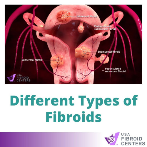 If you have been diagnosed with uterine fibroids, it is important to be aware of the different types and classifications. Learn more-
https://www.usafibroidcenters.com/uterine-fibroids/types-of-fibroids/
