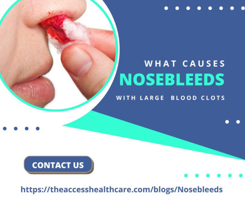 If your nosebleed doesn't stop, or you have a lot of bleeding from your gums or when you get minor cuts, see a doctor. For more information on nosebleeds or to schedule an appointment, don't wait. Contact the expert team at ENT Physicians and Surgeons today.