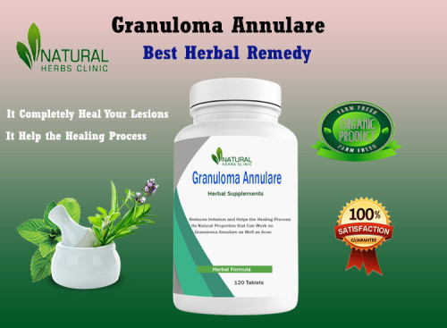 Granuloma Annulare Herbal Treatment commonly used as complementary approaches to help manage symptoms and support the healing process. https://jobhop.co.uk/blog/18307/the-benefits-of-using-granuloma-annulare-herbal-treatment