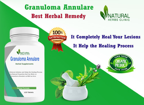 Here we are going to discuses some Natural Remedies for Granuloma Annuale that may help alleviate symptoms and promote healing. https://www.link-your-site.com/blog/12537-Simple-Easy-to-Make-Granuloma-Annulare-Home-Remedies.html