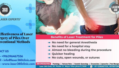 Without a doubt, laser surgery for piles is more successful than traditional procedures. Rapid patient treatment with laser surgery has produced noticeable benefits.
https://laser360clinic.com/the-effectiveness-of-laser-surgery-of-piles-over-conventional-methods/