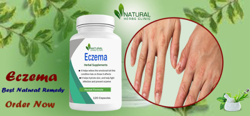 Discover Natural Treatments for Eczema to help relieve the pain and discomfort of eczema on hands and fingers. Learn about home remedies. https://www.natural-health-news.com/best-natural-treatments-for-eczema-on-hands-and-fingers/