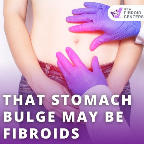 Did you know fibroids can be as big as a watermelon and weigh up to 40 pounds? If your stomach is bulging because of uterine fibroids, you may wonder what is happening. Here is everything you need to know

https://www.usafibroidcenters.com/blog/noticing-stomach-bulge/